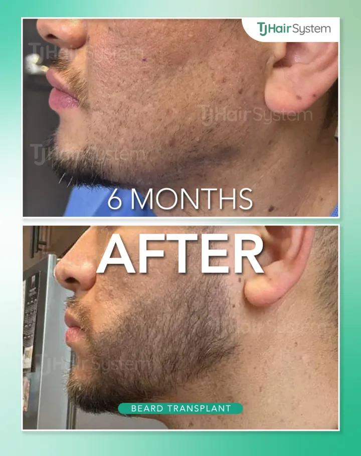 Mandíbula y mentón, trasplante capilar antes y después, 6 meses · cabello oscuro