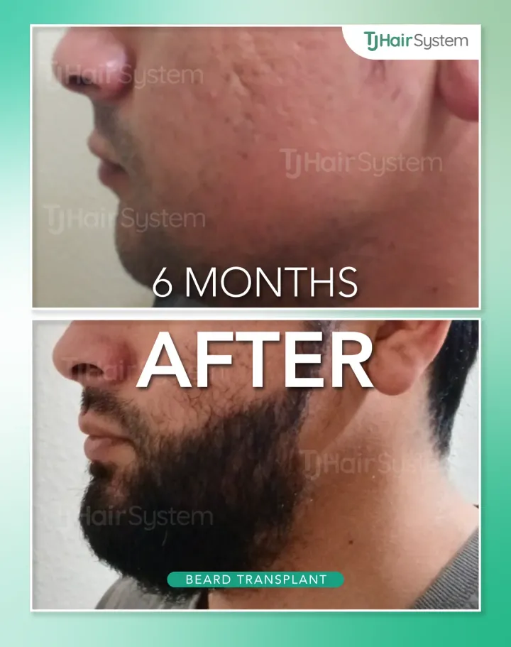 Barba completa, trasplante capilar antes y después, 6 meses · cabello oscuro y grueso