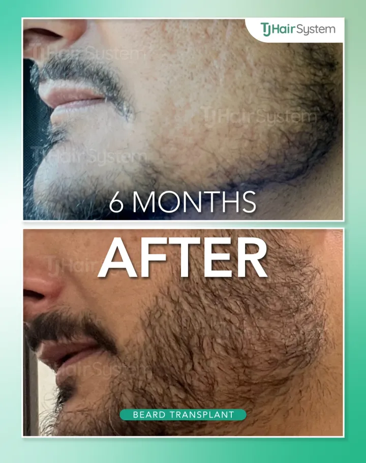 Mejillas y mandíbula, trasplante capilar antes y después, 6 meses · cabello oscuro