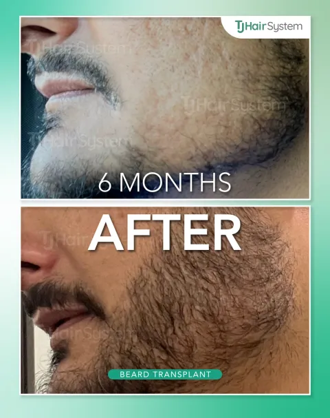 Before and after: Cheeks & jaw, Dark hair, 6 months