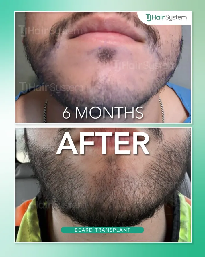 Mentón y barba inferior, trasplante capilar antes y después, 6 meses · cabello oscuro y grueso