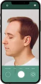Example of a donor area photo