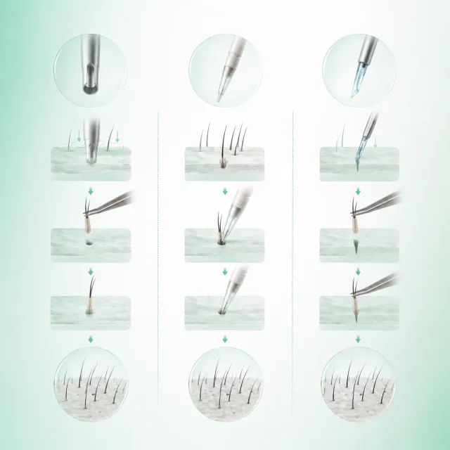 FUE, DHI and Sapphire compared step by step