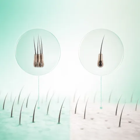 A follicular unit in the skin next to an extracted graft