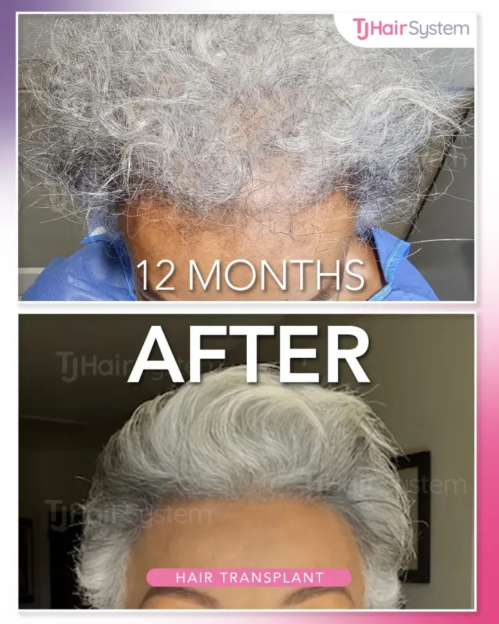Densidad general, trasplante capilar antes y después, 12 meses · cabello grueso y canoso