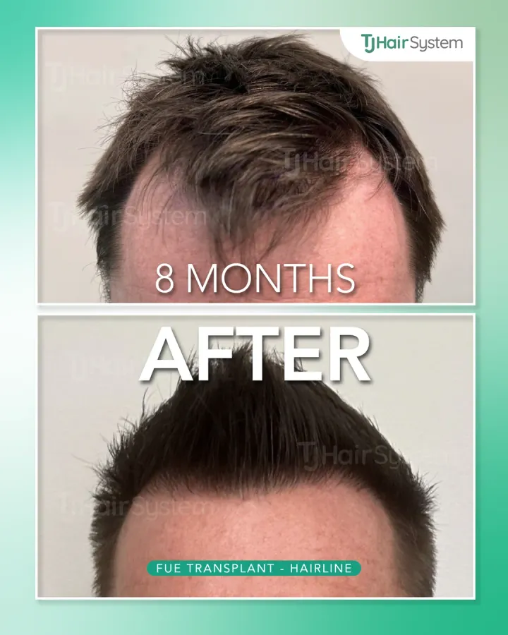 Entradas, trasplante capilar antes y después, 8 meses · cabello lacio y castaño