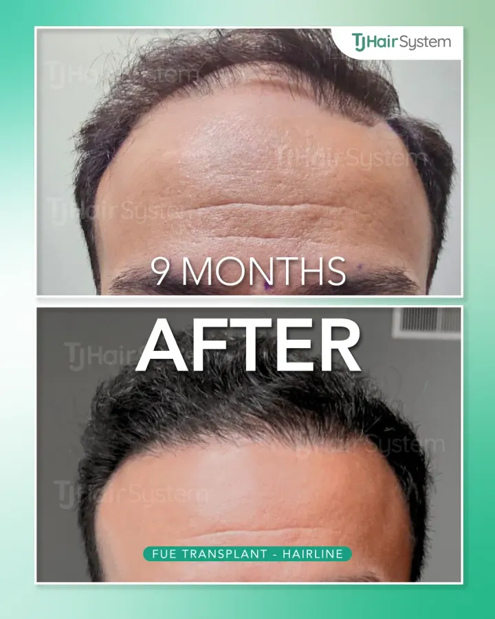 Tercio frontal del cuero cabelludo, trasplante capilar antes y después, 9 meses · cabello lacio y oscuro
