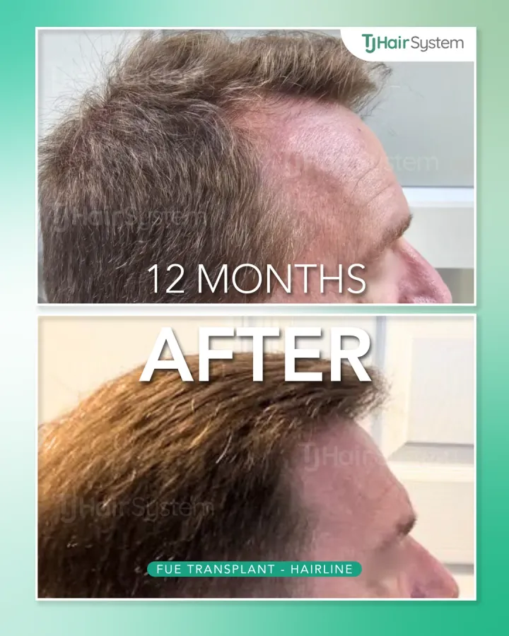 Entradas y perfil lateral, trasplante capilar antes y después, 12 meses · cabello ondulado y castaño