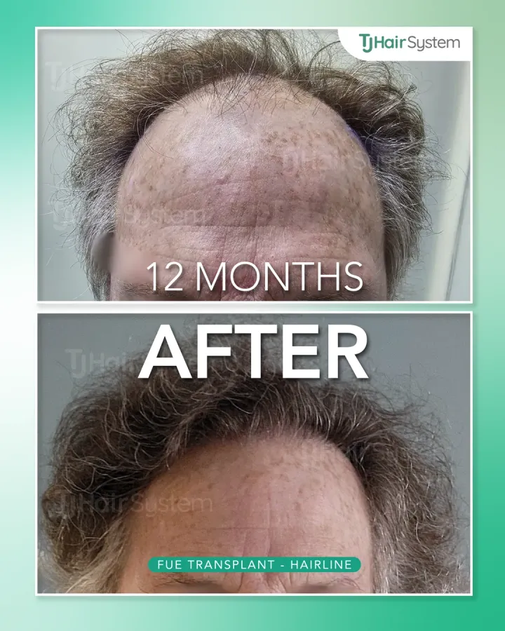 Línea capilar frontal y copete, trasplante capilar antes y después, 12 meses · cabello rizado y castaño