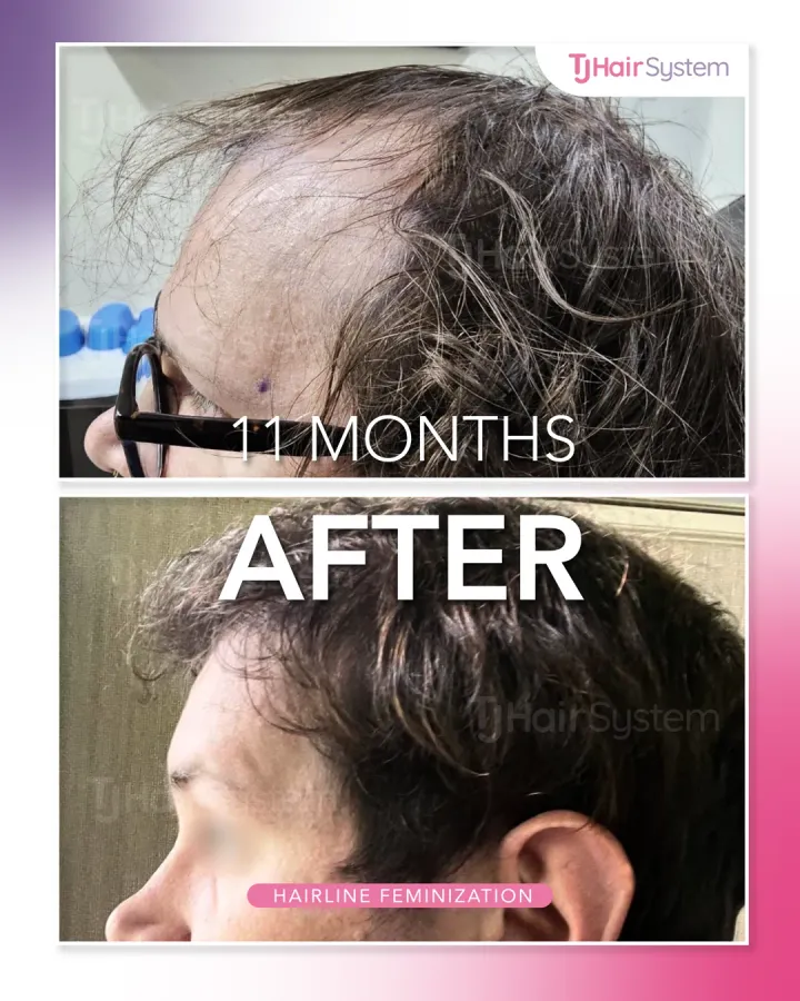 Línea capilar alta y entradas, trasplante capilar antes y después, 11 meses · cabello ondulado y oscuro