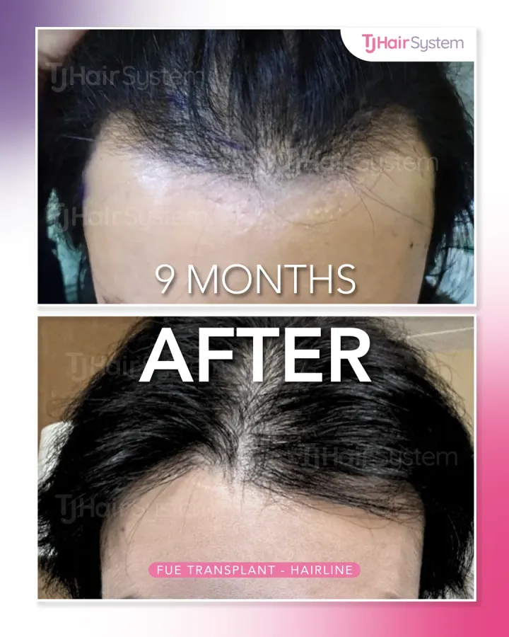 Línea capilar y raya, trasplante capilar antes y después, 9 meses · cabello lacio y negro