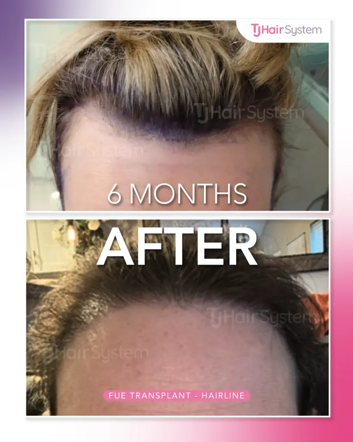 Borde frontal retraído, trasplante capilar antes y después, 6 meses · cabello lacio y rubio