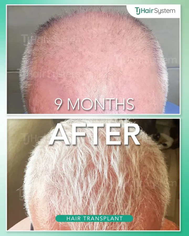 Coronilla y vértice, trasplante capilar antes y después, 9 meses · cabello fino y blanco