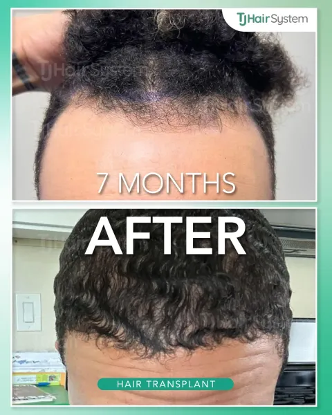 Before and after: Frontal hairline, Curly, dark hair, 7 months