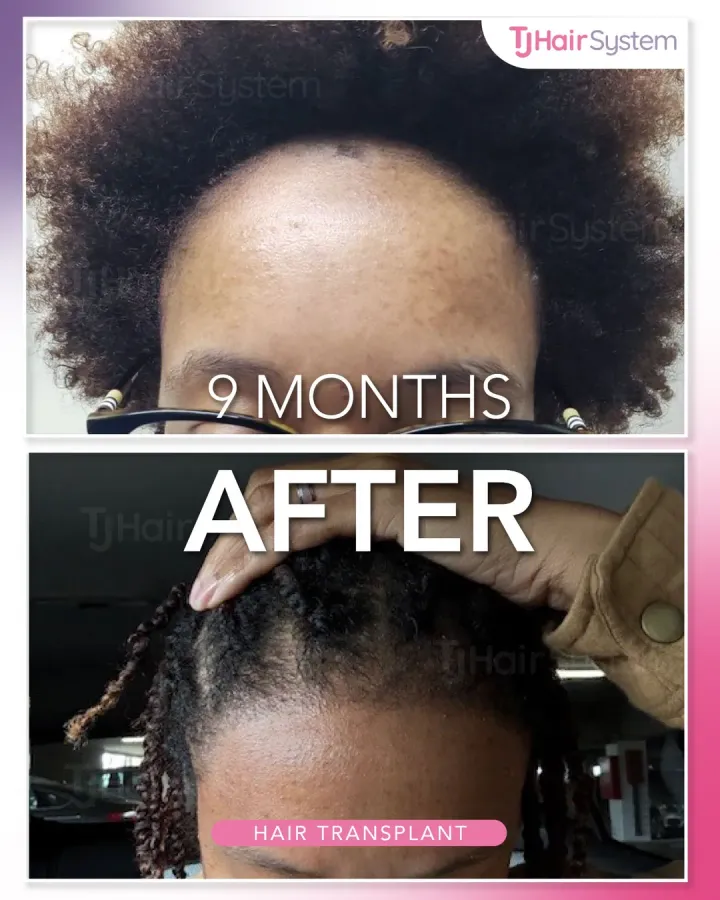 Densidad frontal, trasplante capilar antes y después, 9 meses · cabello afro