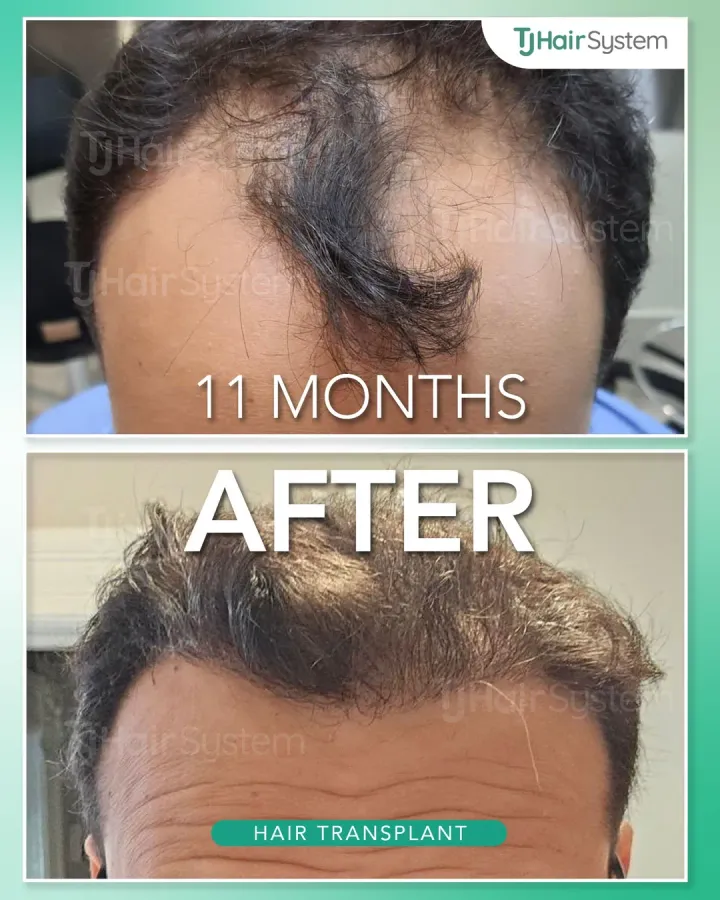 Línea capilar frontal y entradas, trasplante capilar antes y después, 11 meses · cabello lacio y oscuro