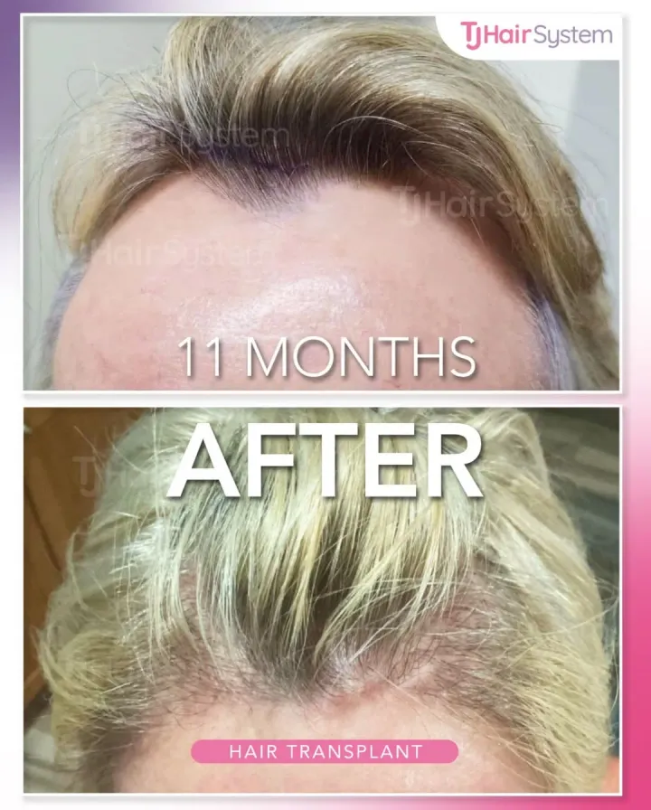 Línea capilar y entradas, trasplante capilar antes y después, 11 meses · cabello fino y rubio
