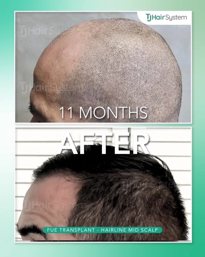 Línea capilar y zona media, trasplante capilar antes y después, 11 meses · cabello lacio y oscuro