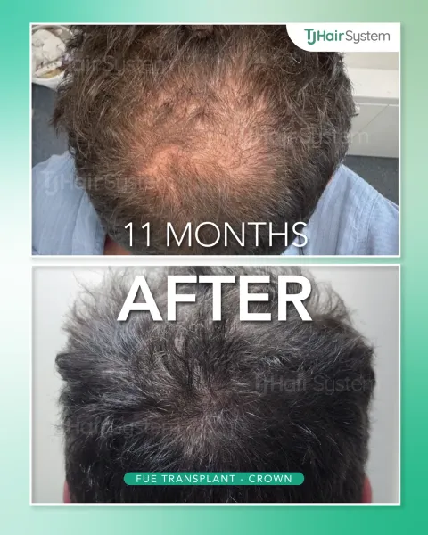 Before and after: Crown, Wavy, dark hair, 11 months