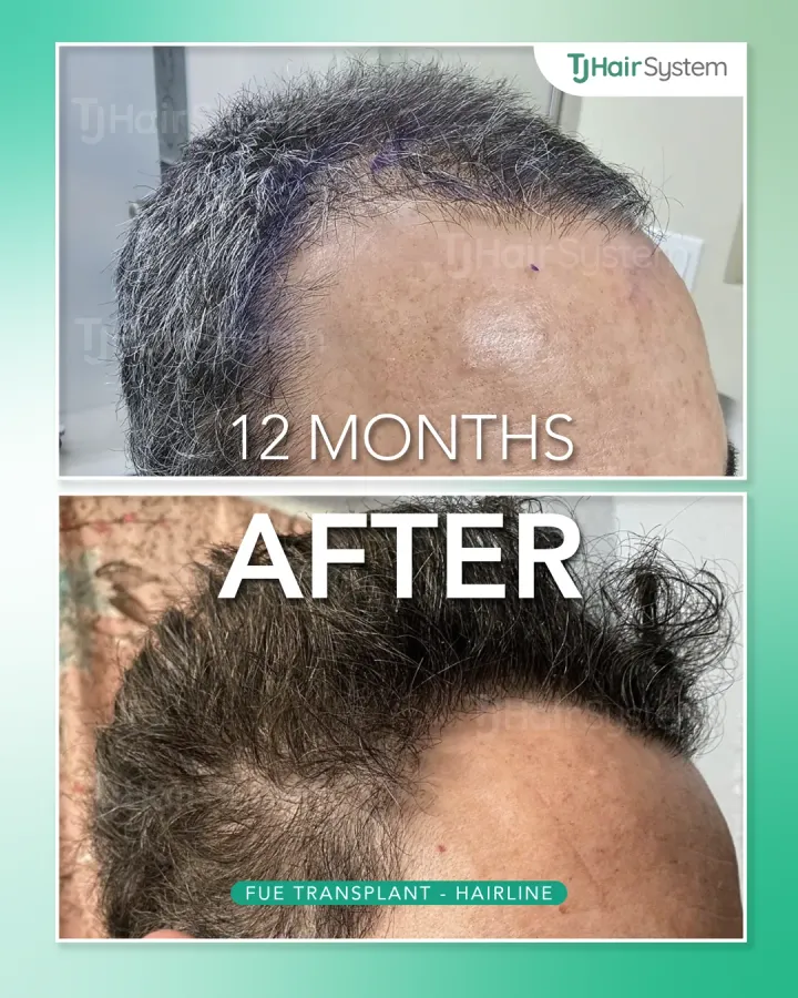 Entrada frontal marcada, trasplante capilar antes y después, 12 meses · cabello ondulado y oscuro
