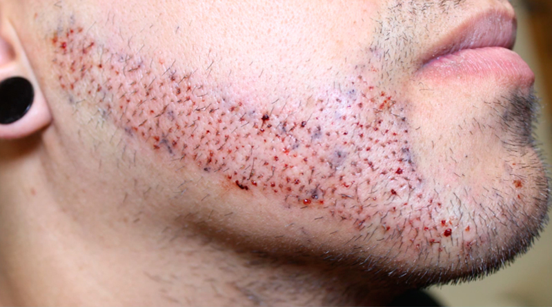 Beard Transplant in Mexico | TJ Hair Clinic Beard Transplant in Mexico | TJ Hair Clinic