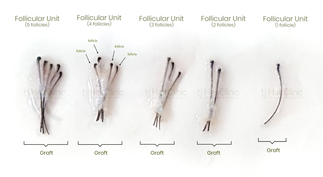 What's the difference between a hair graft and a follicle? | TJ Hair Clinic