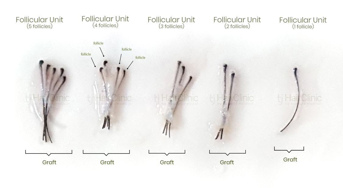 What's the difference between a hair graft and a follicle? | TJ Hair Clinic What's the difference between a hair graft and a follicle? | TJ Hair Clinic