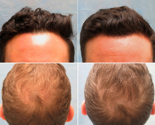 Know the PRP Hair Treatment Cost in Mumbai  Artius Hair Transplant   Cosmetic Surgery Mumbai