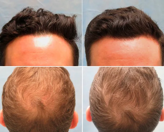 PRP Hair-Loss Therapy Treatment in Mexico $350 PRP Hair-Loss Therapy Treatment in Mexico $350