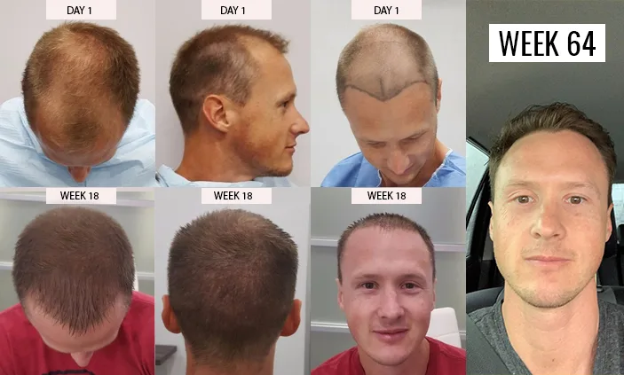 Hair Transplant in Mexico, Tijuana - FUE $3,800 | BBB Certified