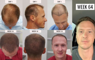Hair Transplant in Mexico, Tijuana - FUE | BBB Certified