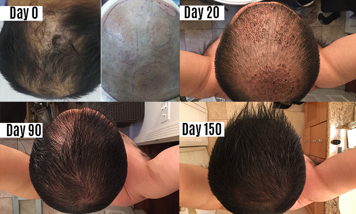 Hair Transplant in Mexico, Tijuana - FUE | BBB Certified