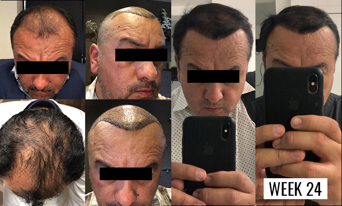 Hair Transplant in Mexico, Tijuana - FUE $3,800 | BBB Certified