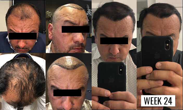 Hair Transplant in Mexico, Tijuana - FUE | BBB Certified