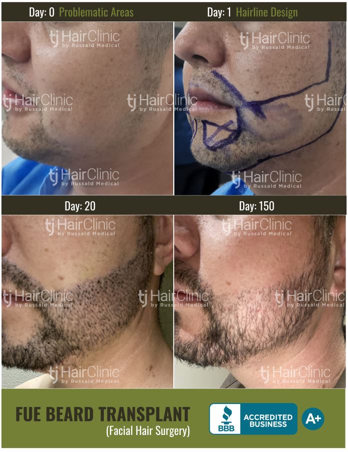 beard hair transplant result india