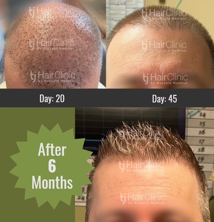 Post Op Recovery Photographs – 2 Weeks After FUE Hair Transplant Procedure