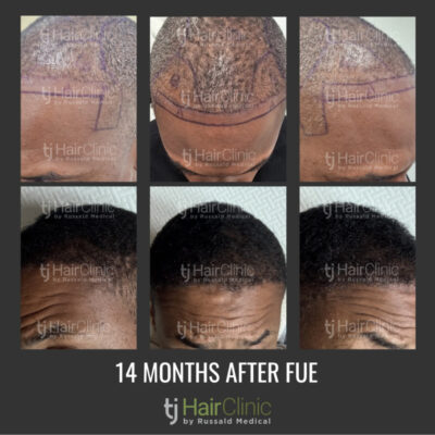 Before and After Hair Transplant Patients in Tijuana
